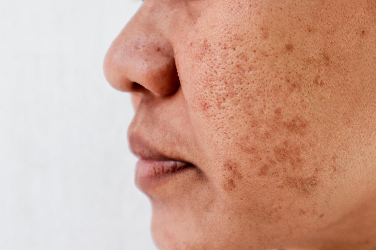 Glutathione Injection for Hyperpigmentation | CLNQ