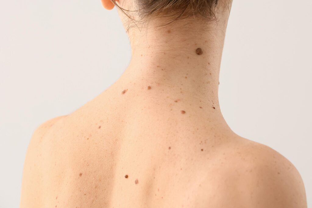 mole removal cost