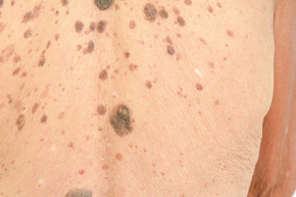 senile wart removal