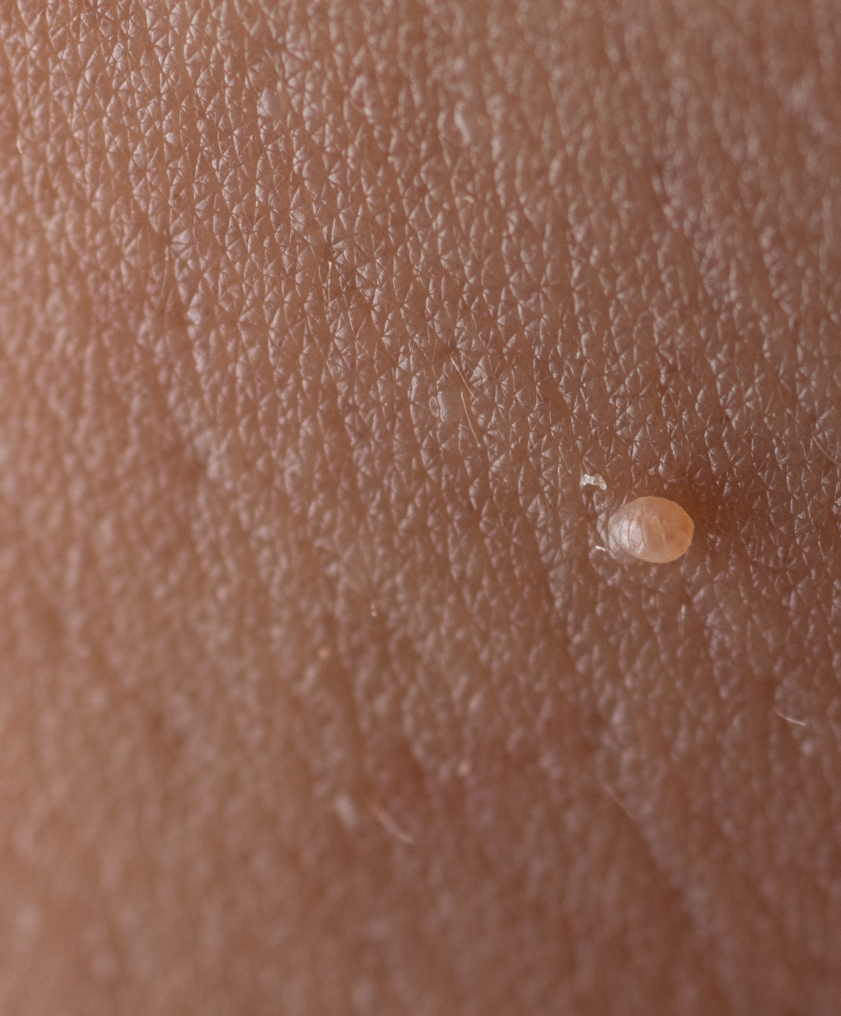 skin tag removal Manchester Cheshire