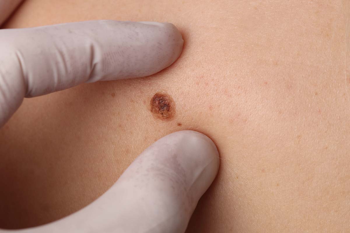 birthmark removal