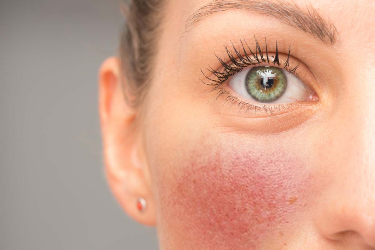 vbeam laser for vascular lesions pdl laser Manchester rosacea laser treatment