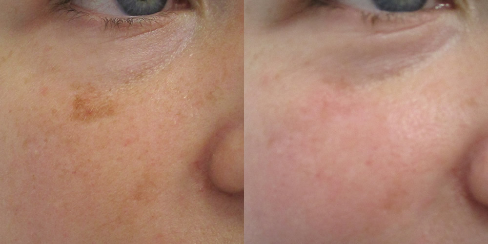 sun spot laser mole removal