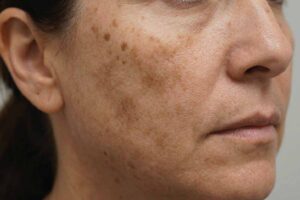 hyperpigmentation-sunspots-face