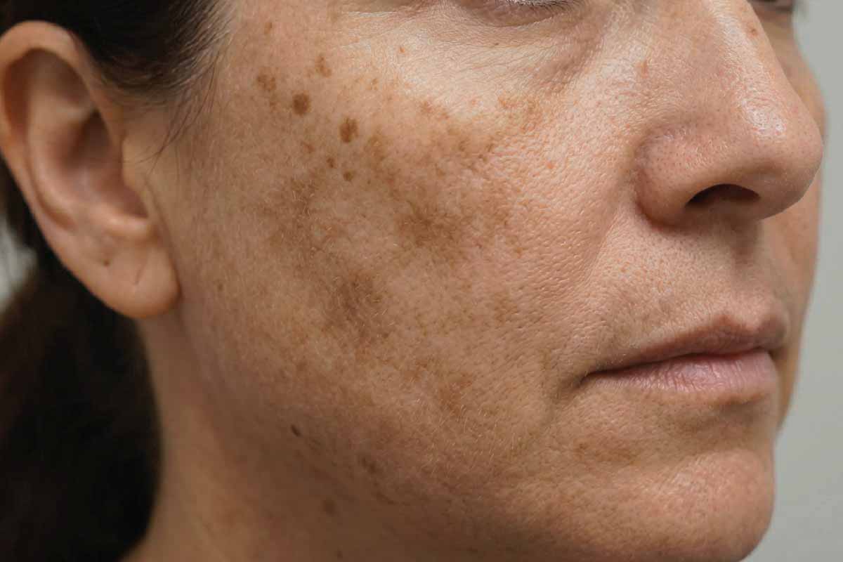 hyperpigmentation-sunspots-face